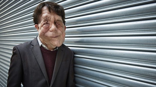 Photo c/o: BBC, The Ugly Face Of Disability Hate Crime