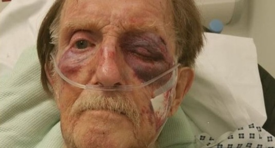 Bob Gumbley suffered severe bruising to his face  Credit: Staffordshire Police