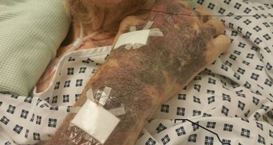 Bob Gumbley's injuries include bruising to his hands and right arm Credit: Staffordshire Police