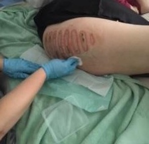 Red marks on the woman's leg photographed the next day.