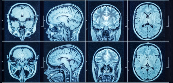 MRI imaging brain scans. Credit: Triff/ Shutterstock