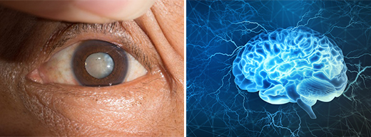 Scientists find link between cataract surgery and reduced risk of dementia