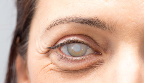 cataract surgery
